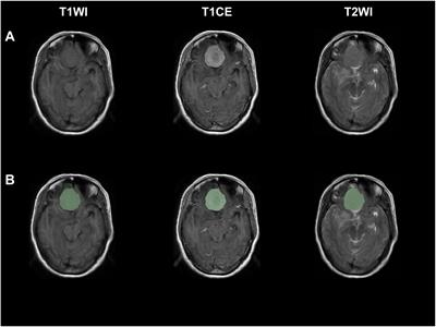 Multi-parameter MRI radiomic features may contribute to predict progression-free survival in patients with WHO grade II meningiomas